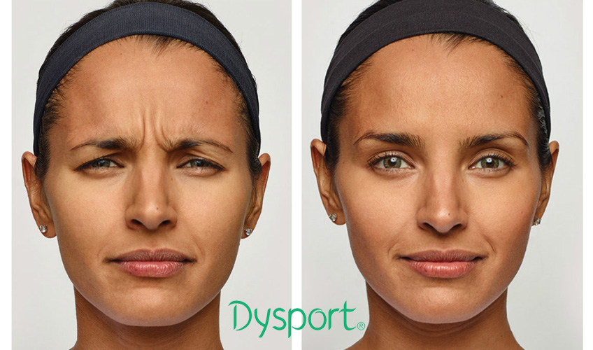 Dysport-Milpitas-CA