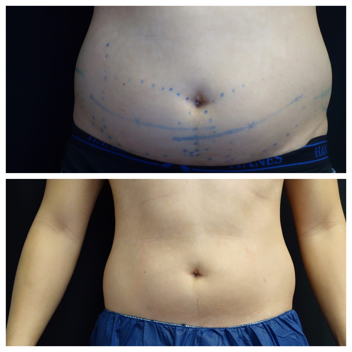 Coolsculpting – Milpitas